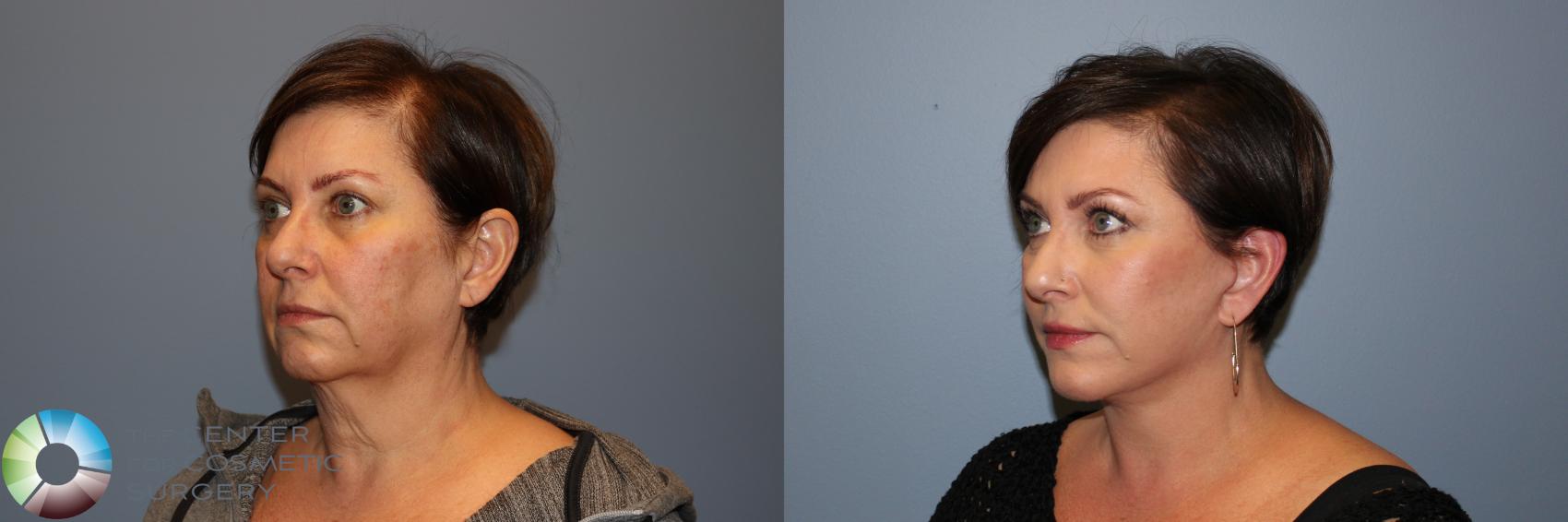 Before & After Mini Facelift Case 11877 Left Oblique in Denver and Colorado Springs, CO