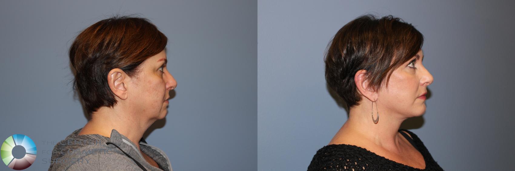 Before & After Mini Facelift Case 11877 Right Side in Denver and Colorado Springs, CO