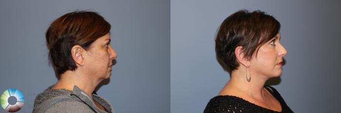 Before & After Mini Facelift Case 11877 Right Side View in Golden, CO