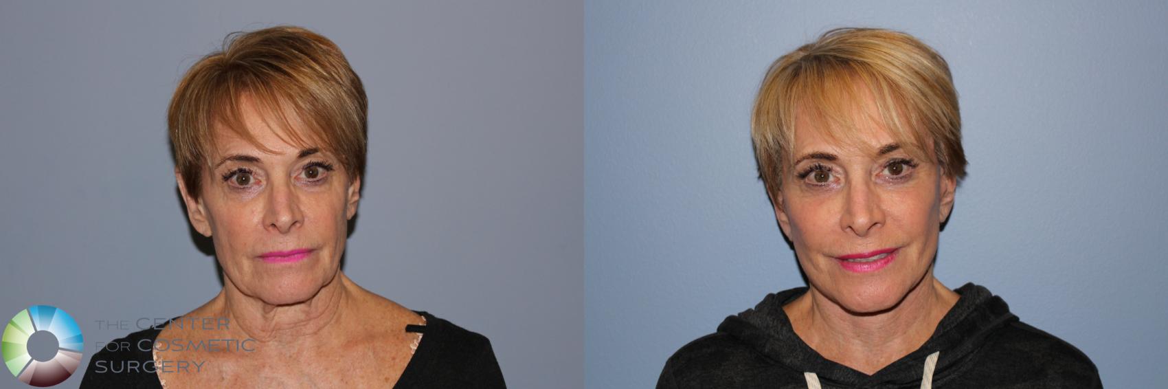 Before & After Facelift Case 11880 Front in Denver and Colorado Springs, CO