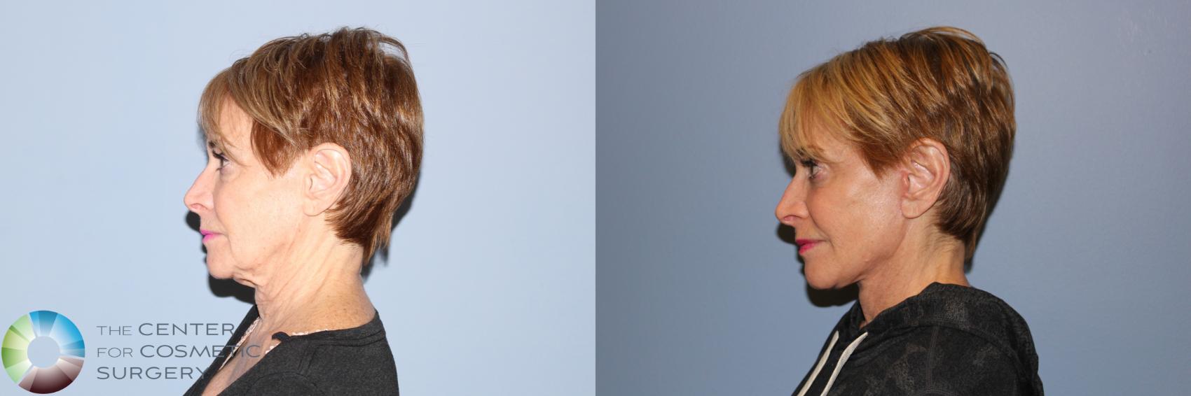 Before & After Mini Facelift Case 11880 Left Side in Denver and Colorado Springs, CO