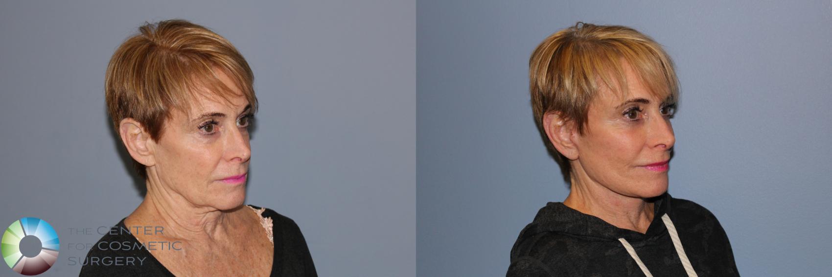 Before & After Mini Facelift Case 11880 Right Oblique in Denver and Colorado Springs, CO