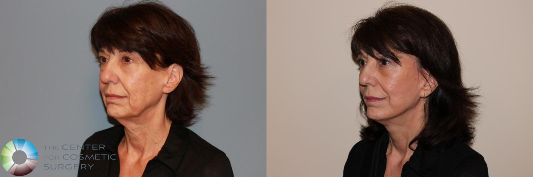 Before & After Mini Facelift Case 11882 Left Oblique in Denver and Colorado Springs, CO