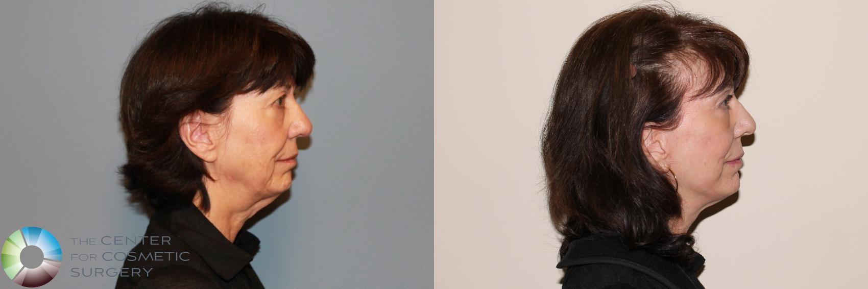 Before & After Mini Facelift Case 11882 Right Side in Denver and Colorado Springs, CO