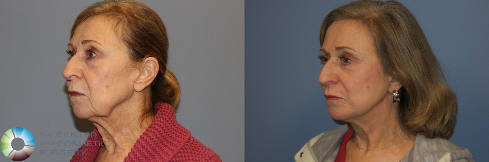 Before & After Mini Facelift Case 11885 Left Oblique in Denver and Colorado Springs, CO