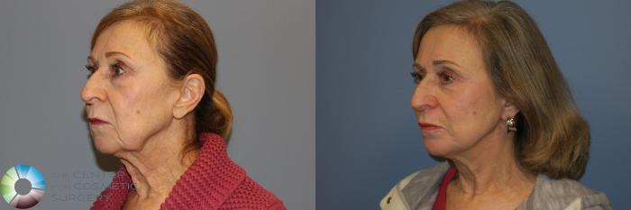 Before & After Mini Facelift Case 11885 Left Oblique View in Golden, CO