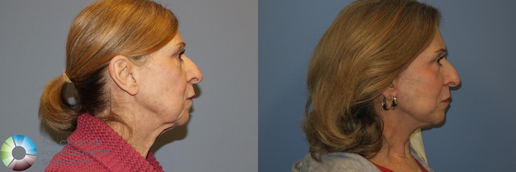 Before & After Mini Facelift Case 11885 Right Side in Denver and Colorado Springs, CO