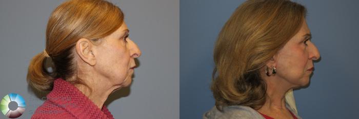 Before & After Mini Facelift Case 11885 Right Side View in Golden, CO