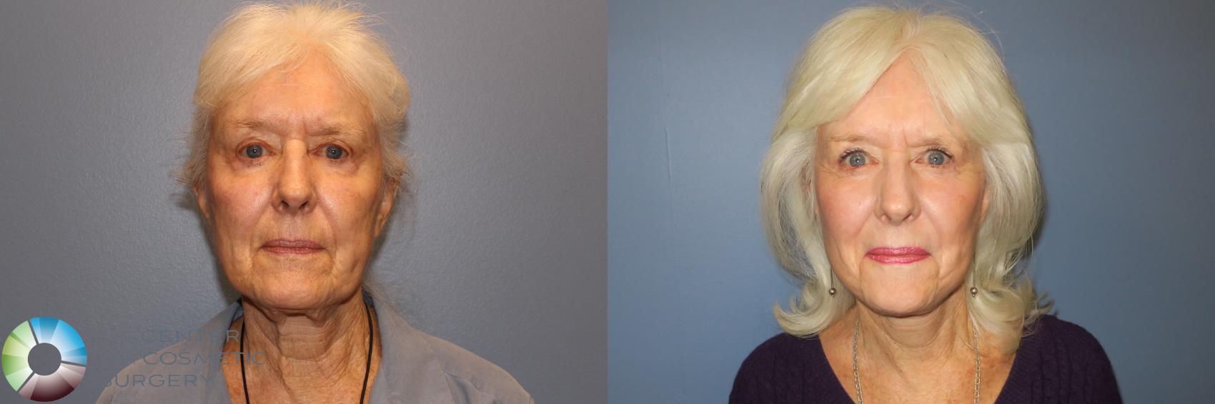 Before & After Mini Facelift Case 11888 Front in Denver and Colorado Springs, CO