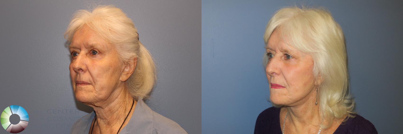 Before & After Mini Facelift Case 11888 Left Oblique in Denver and Colorado Springs, CO