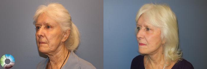 Before & After Mini Facelift Case 11888 Left Oblique View in Golden, CO