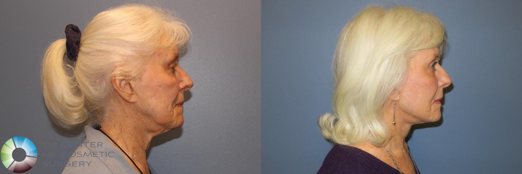 Before & After Mini Facelift Case 11888 Right Side in Denver and Colorado Springs, CO