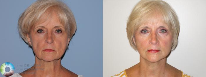 Before & After Mini Facelift Case 11890 Front in Denver and Colorado Springs, CO