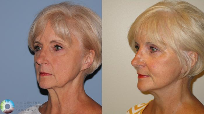 Before & After Mini Facelift Case 11890 Left Oblique in Denver and Colorado Springs, CO