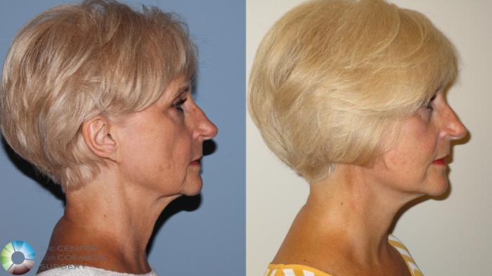 Before & After Mini Facelift Case 11890 Right Side in Denver and Colorado Springs, CO