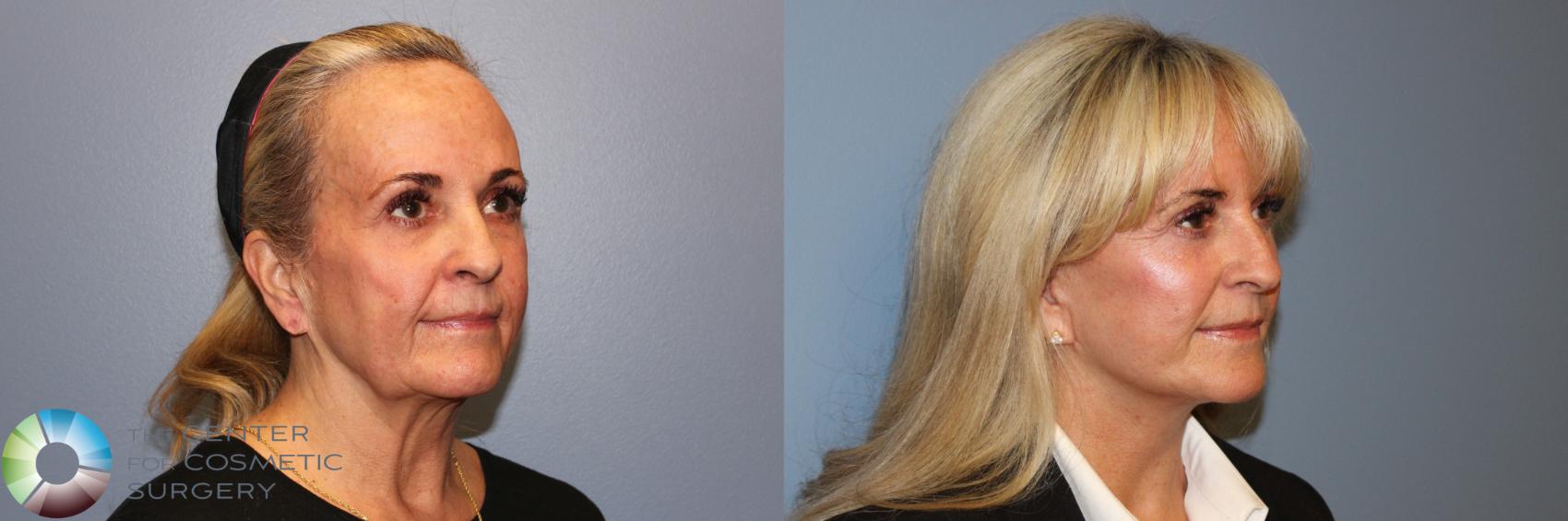 Before & After Mini Facelift Case 11891 Right Oblique in Denver and Colorado Springs, CO
