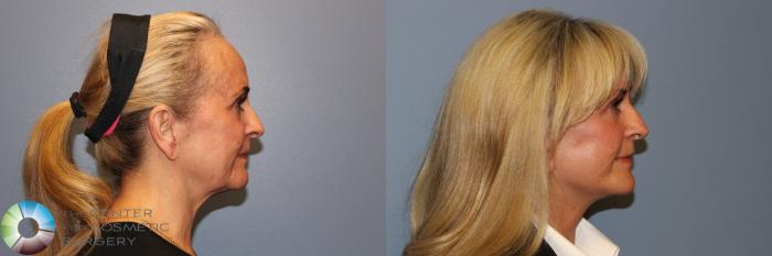 Before & After Mini Facelift Case 11891 Right Side View in Golden, CO