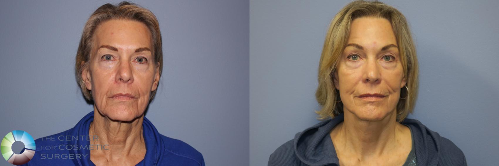 Before & After Mini Facelift Case 11892 Front in Denver and Colorado Springs, CO