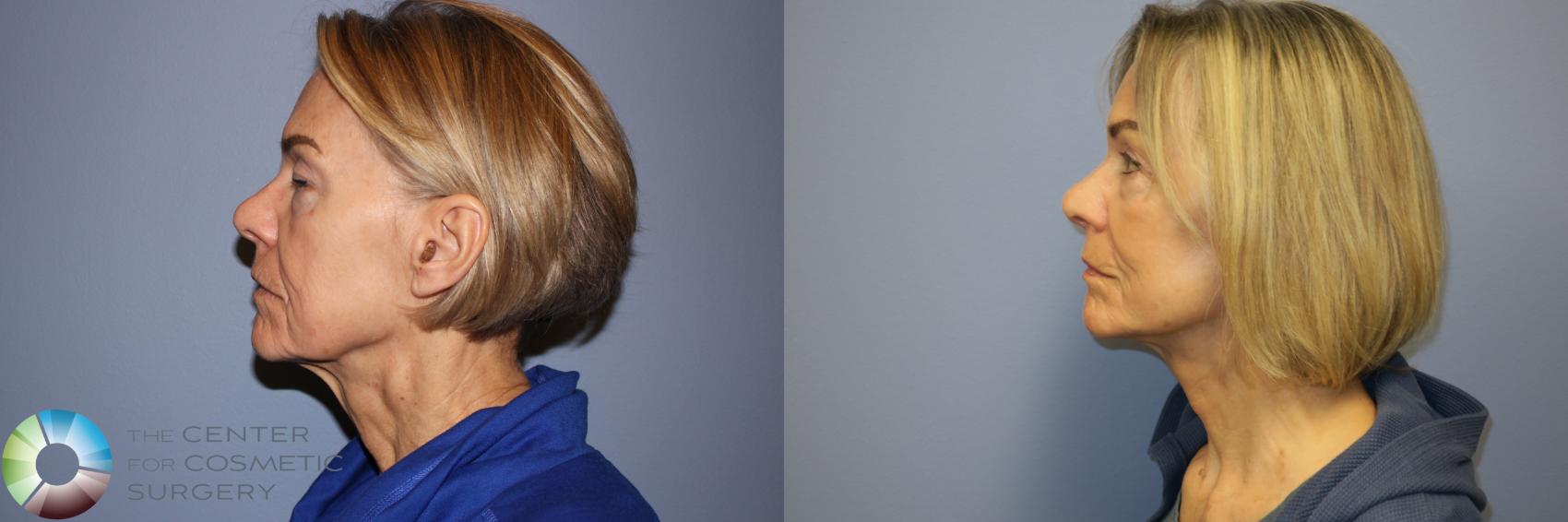 Before & After Mini Facelift Case 11892 Left Side in Denver and Colorado Springs, CO