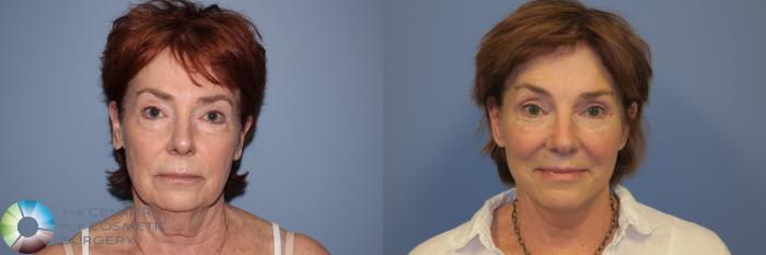 Before & After Mini Facelift Case 11895 Front View in Golden, CO