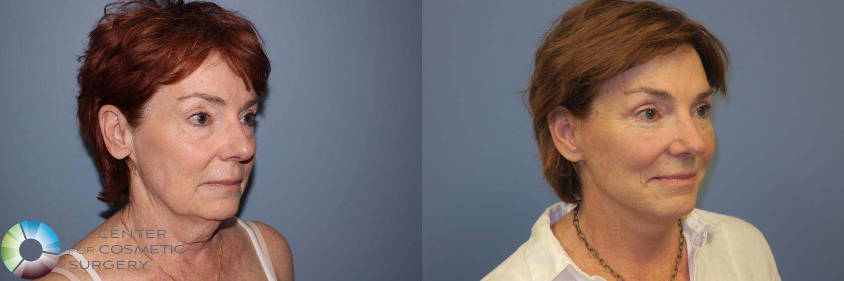 Before & After Mini Facelift Case 11895 Right Oblique in Denver and Colorado Springs, CO