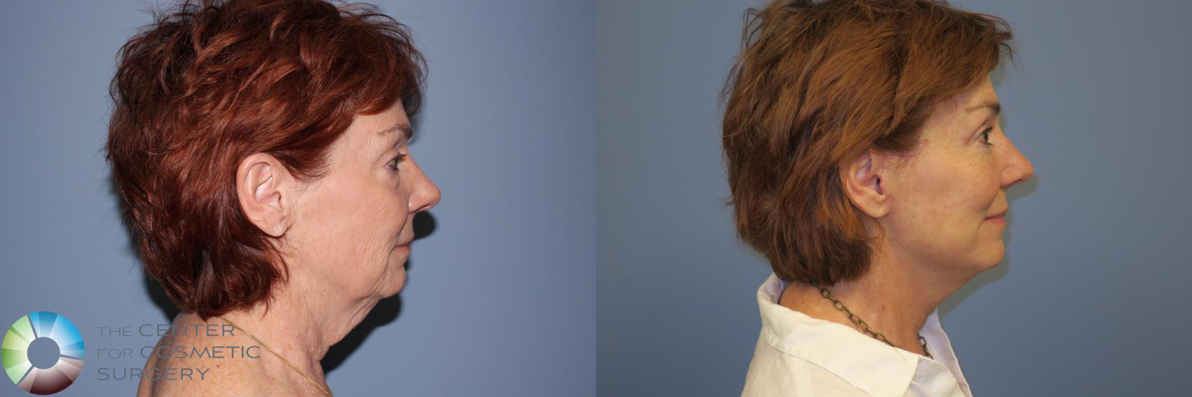 Before & After Mini Facelift Case 11895 Right Side in Denver and Colorado Springs, CO