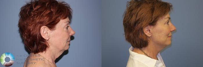 Before & After Mini Facelift Case 11895 Right Side View in Golden, CO