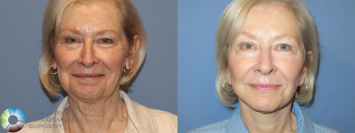 Before & After Neck Lift Case 11903 Front View in Golden, CO