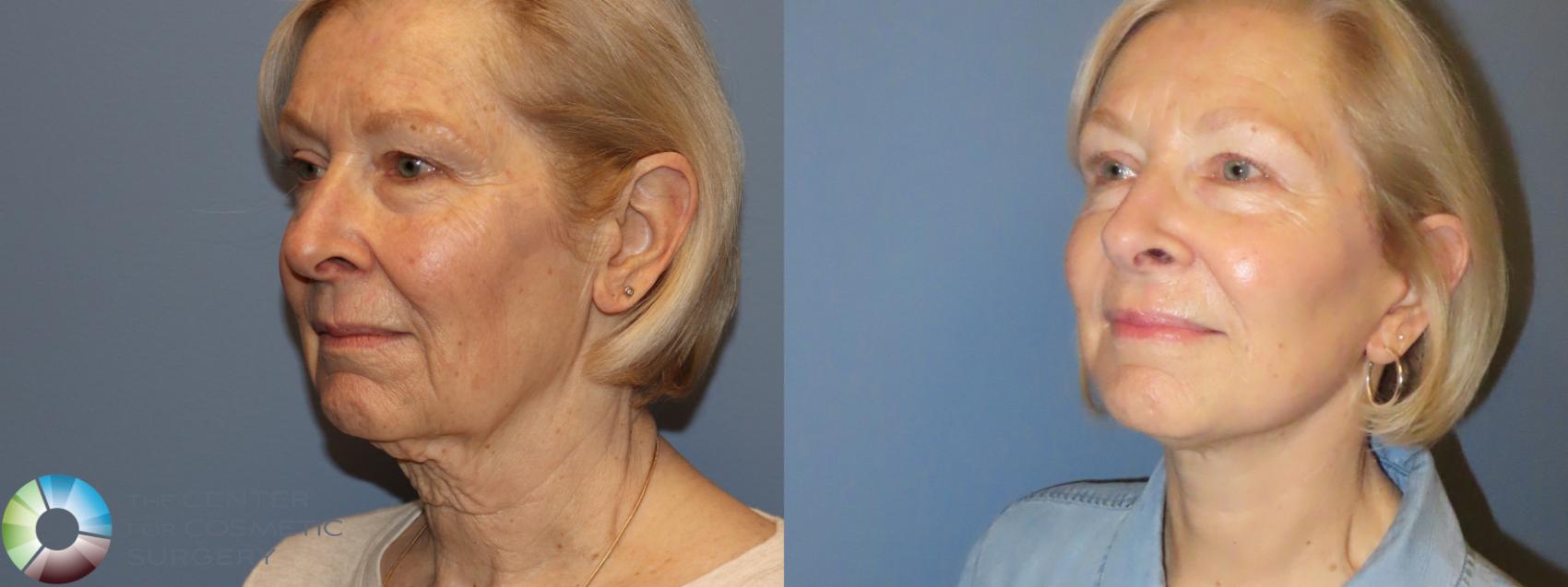 Before & After Neck Lift Case 11903 Left Oblique View in Golden, CO