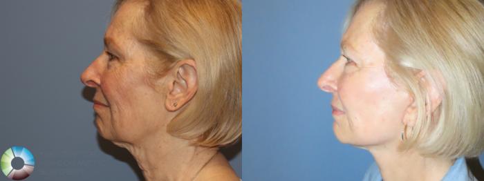 Before & After Neck Lift Case 11903 Left Side View in Golden, CO