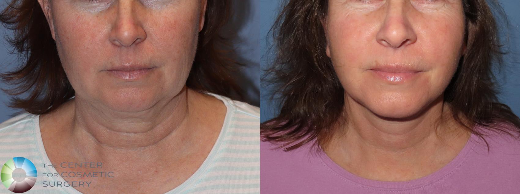 Before & After Mini Facelift Case 11904 Front in Denver and Colorado Springs, CO