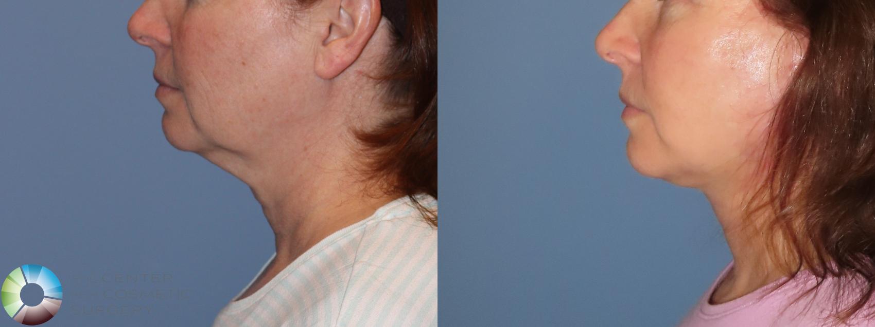 Before & After Mini Facelift Case 11904 Left Side in Denver and Colorado Springs, CO