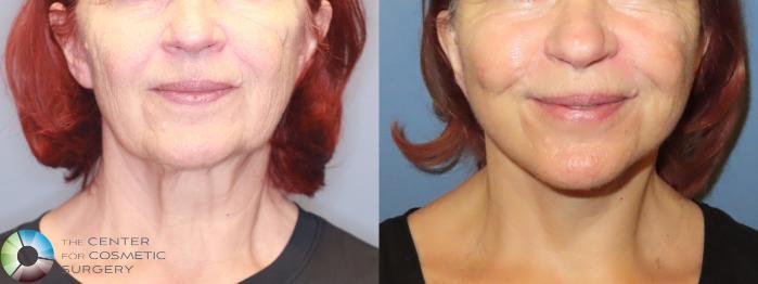 Before & After Mini Facelift Case 11905 Front in Denver and Colorado Springs, CO