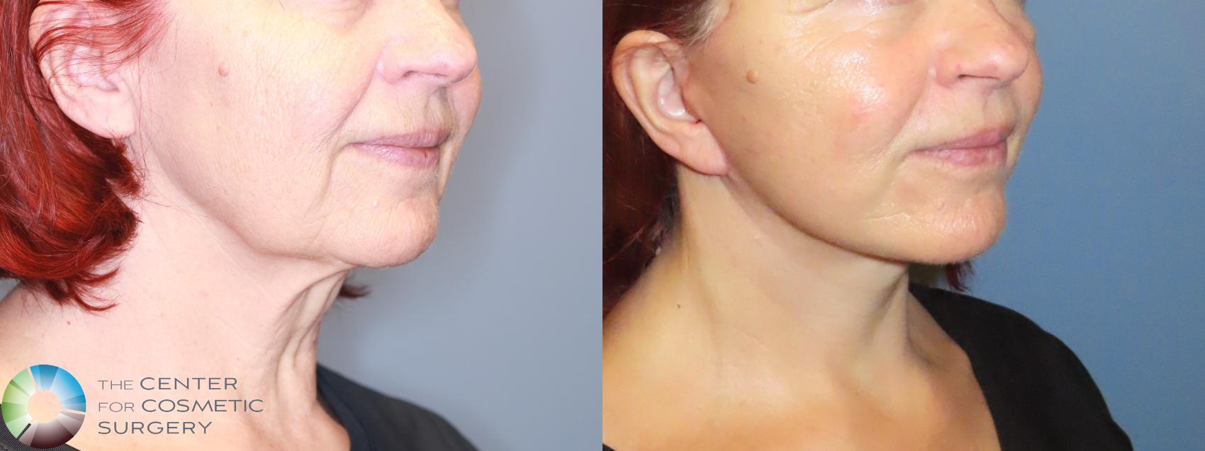 Before & After Mini Facelift Case 11905 Right Oblique in Denver and Colorado Springs, CO