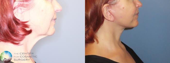 Before & After Mini Facelift Case 11905 Right Side in Denver and Colorado Springs, CO