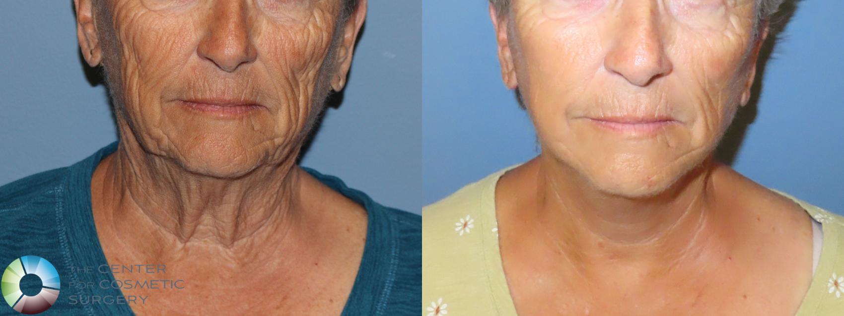 Before & After Neck Lift Case 11906 Front in Denver and Colorado Springs, CO