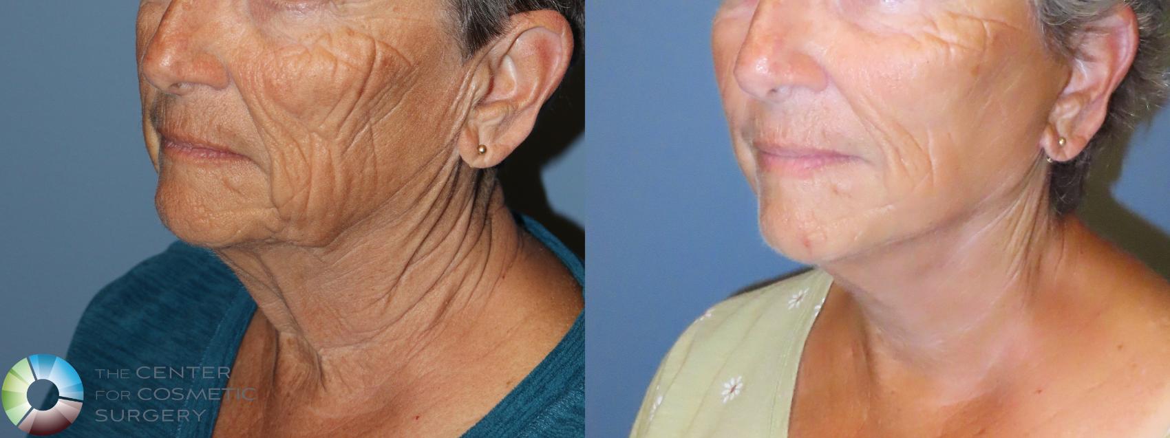 Before & After Mini Facelift Case 11906 Left Oblique in Denver and Colorado Springs, CO