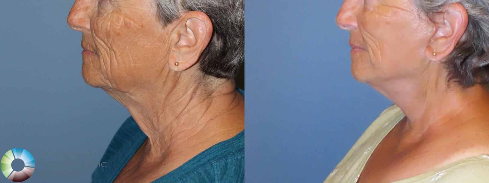 Before & After Mini Facelift Case 11906 Left Side in Denver and Colorado Springs, CO