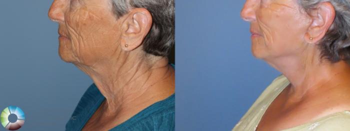 Before & After Mini Facelift Case 11906 Left Side View in Golden, CO
