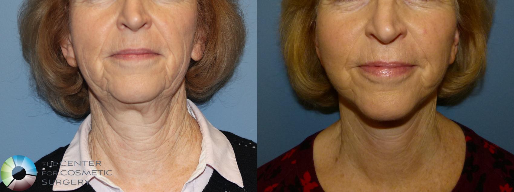 Before & After Mini Facelift Case 11907 Front in Denver and Colorado Springs, CO