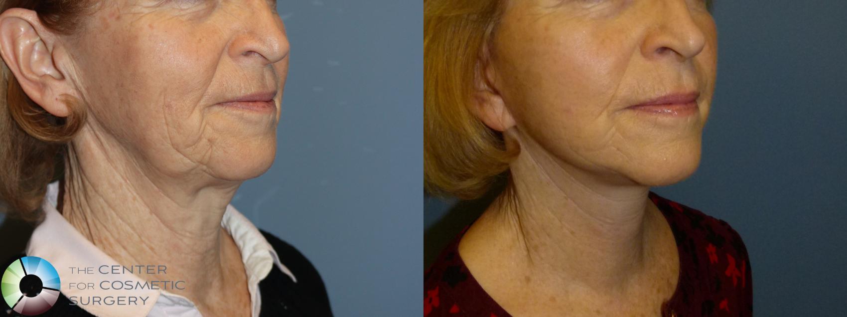 Before & After Mini Facelift Case 11907 Right Oblique in Denver and Colorado Springs, CO