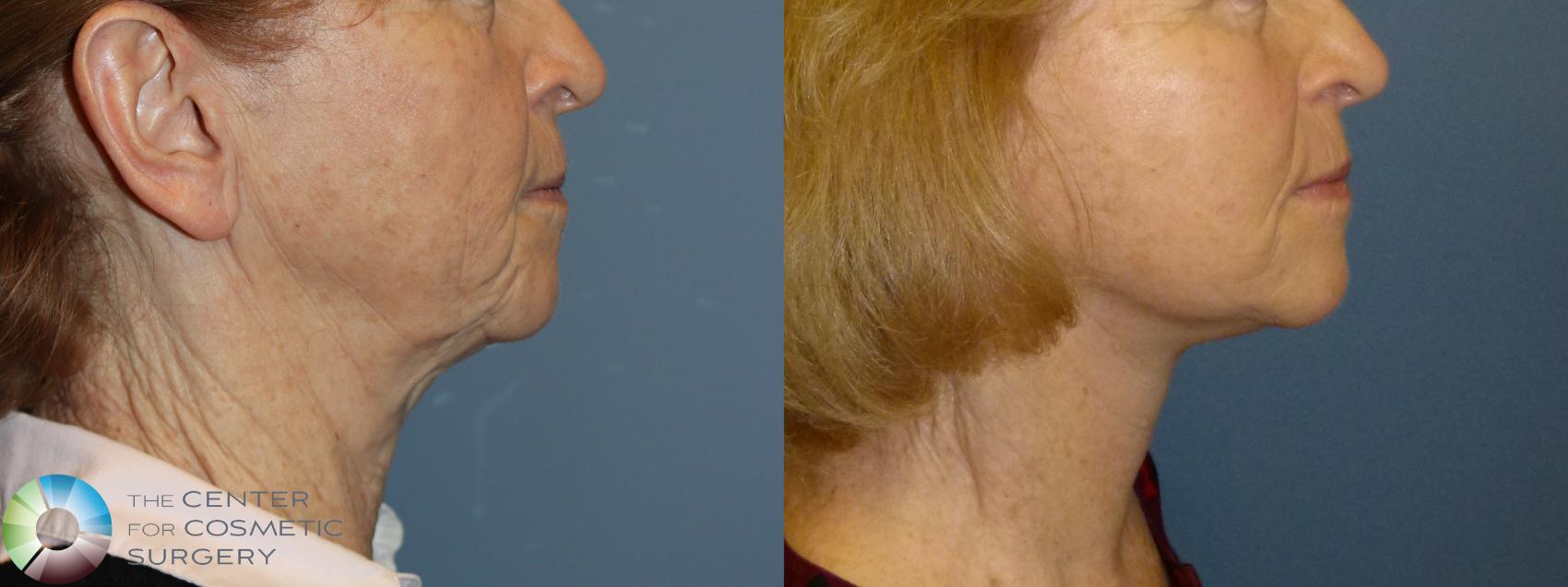 Before & After Mini Facelift Case 11907 Right Side View in Golden, CO