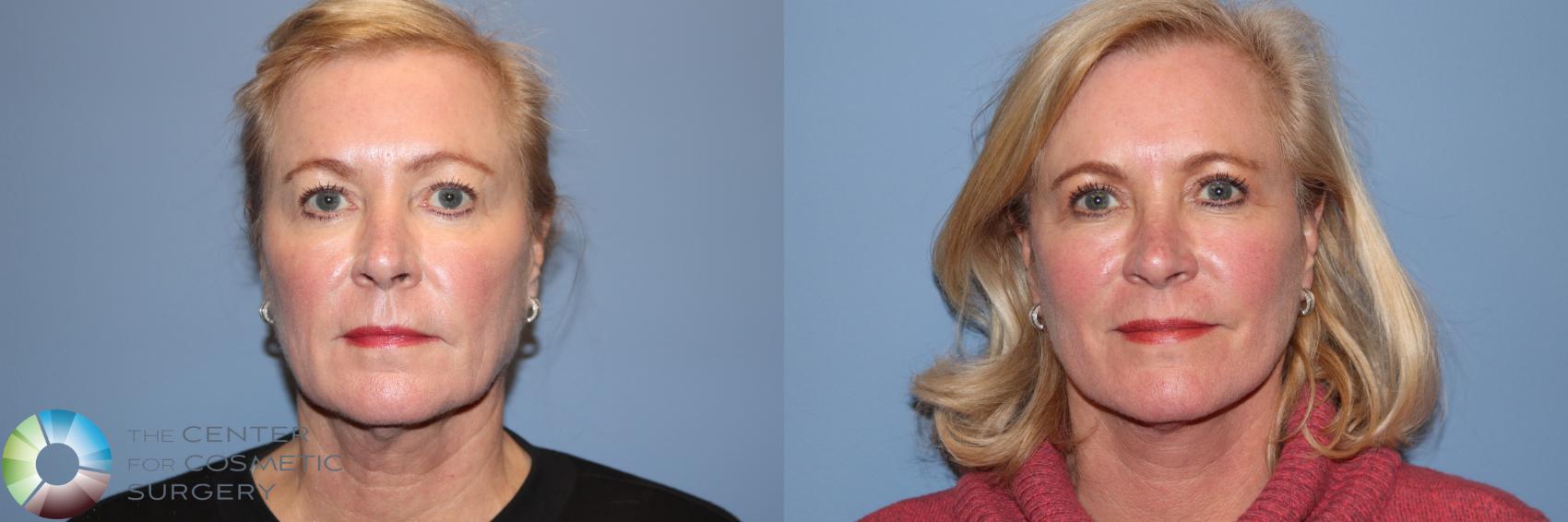 Before & After Mini Facelift Case 11951 Front in Denver and Colorado Springs, CO