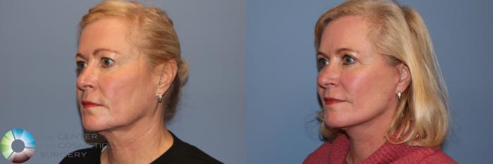 Before & After Mini Facelift Case 11951 Left Oblique in Denver and Colorado Springs, CO