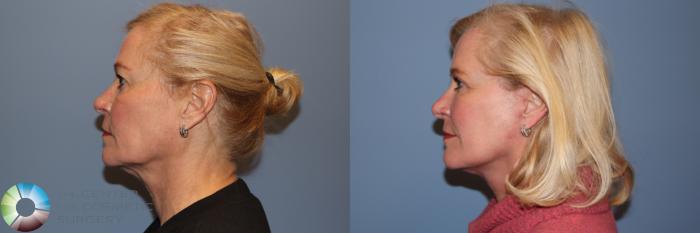 Before & After Mini Facelift Case 11951 Left Side in Denver and Colorado Springs, CO