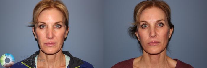 Before & After Mini Facelift Case 11952 Front in Denver and Colorado Springs, CO