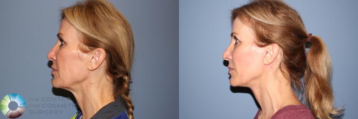 Before & After Mini Facelift Case 11952 Left Side in Denver and Colorado Springs, CO