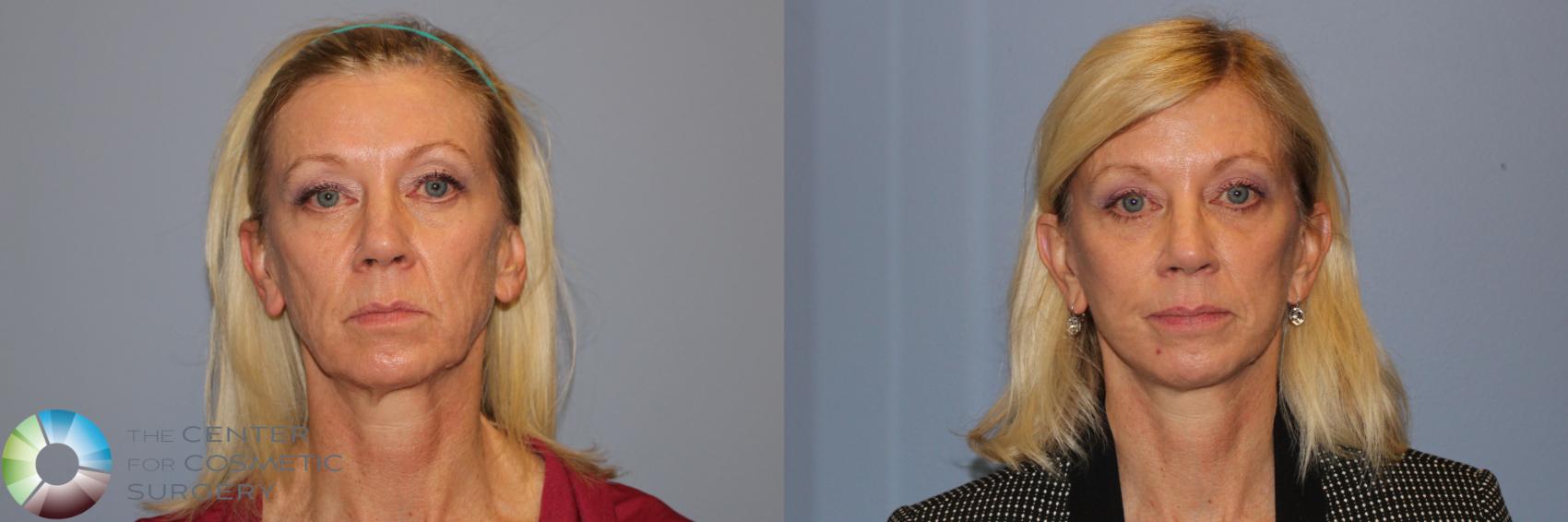 Before & After Mini Facelift Case 11954 Front in Denver and Colorado Springs, CO
