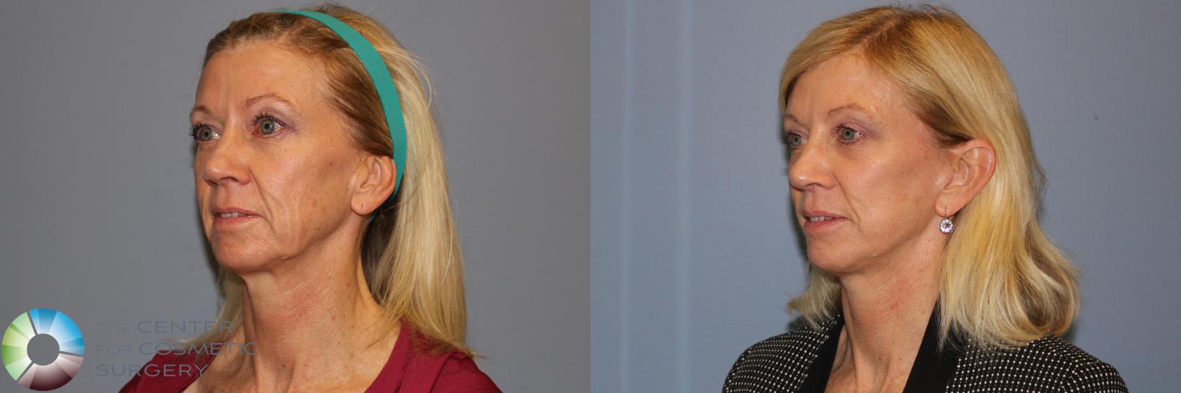 Before & After Mini Facelift Case 11954 Left Oblique in Denver and Colorado Springs, CO
