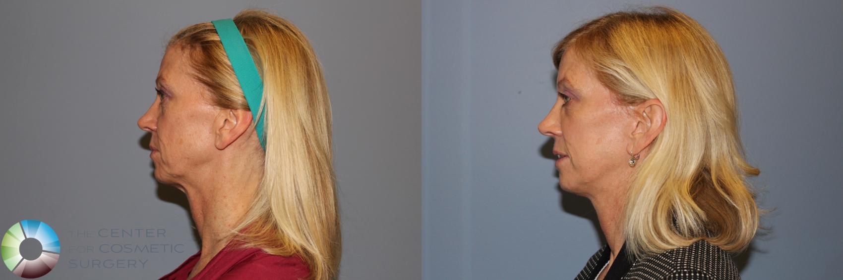 Before & After Mini Facelift Case 11954 Left Side in Denver and Colorado Springs, CO